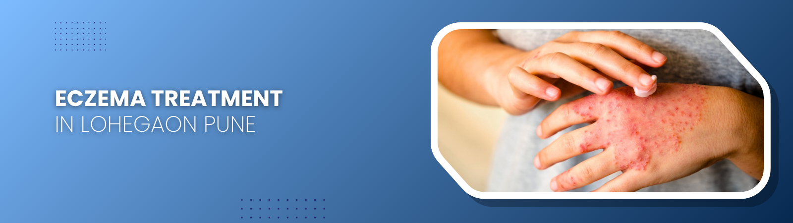 Banner image: hand with eczema inside a white rounded frame on a blue gradient background advertising eczema treatment in Lohegaon, Pune.